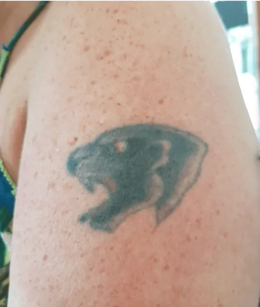 Medium body tattoo before treatment