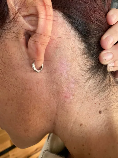 Neck tattoo after removal