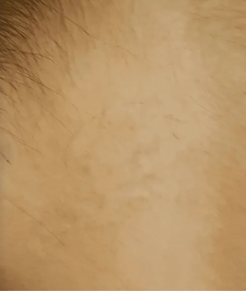 Body tattoo after treatment